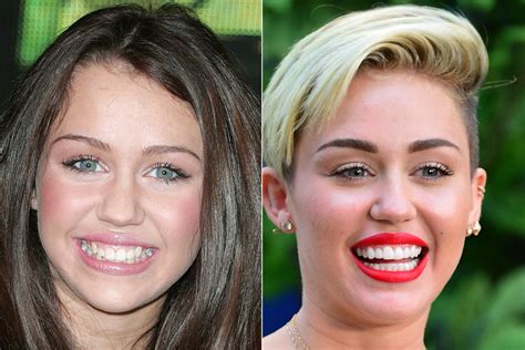 Celebrities Gone Dental: Before And After Photos Of Toothy ...