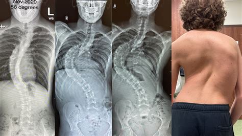 Canadian kids' spinal surgery waits 'far exceed' recommendations ...