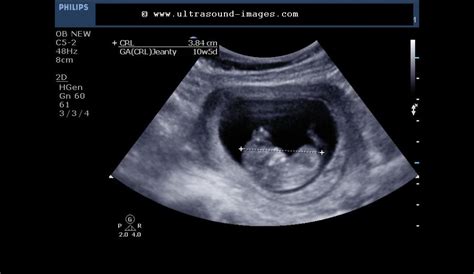 Ultrasound imaging: Fetal 3D-ultrasound images at 10 weeks