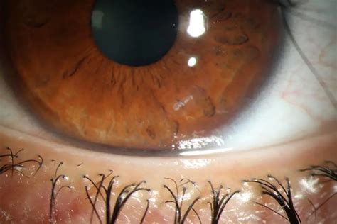 Local condition associated with ocular pain - American Academy of ...