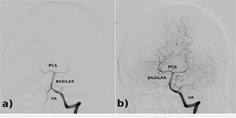 Cerebral angiogram of the left vertebral artery. Cerebral angiogram ...