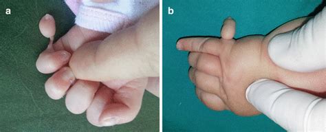 Polydactyly | Plastic Surgery Key