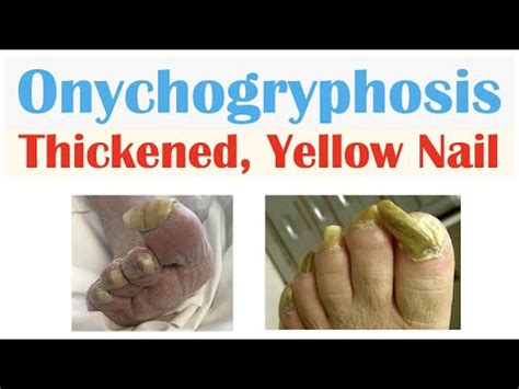 Onychogryphosis (Thickened, Yellow Nails) | Causes, Signs & Symptoms ...