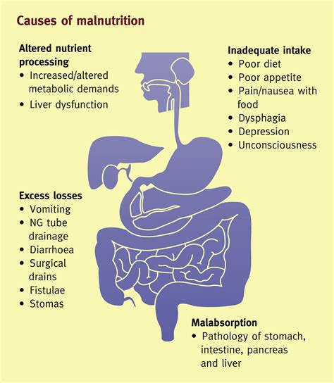 Malnutrition and undernutrition - Medicine