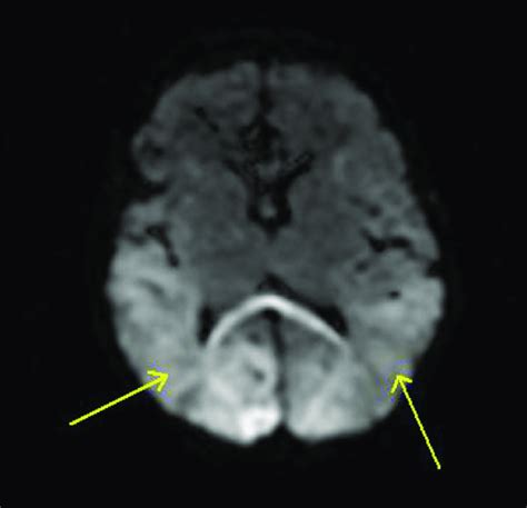 MRI brain diffusion-weighted sequences "demonstrate restricted ...