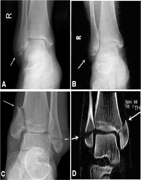 Medial Malleolus Fracture Splint