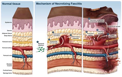 Necrotizing Fasciitis Early Stages