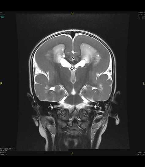 Lissencephaly | Image | Radiopaedia.org