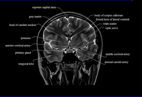 Mri Brain Coronal Cross Sectional Anatomy Image Brain Anatomy Mri | The ...