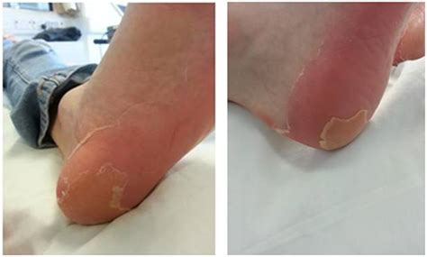 Epithelial desquamation observed in a phase I study of an oral ...