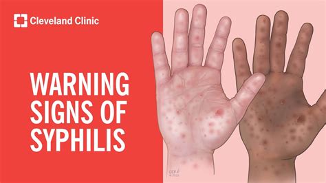 Warning Signs of Syphilis - YouTube