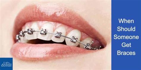 Pros and Cons of Braces - LA Dental Clinic