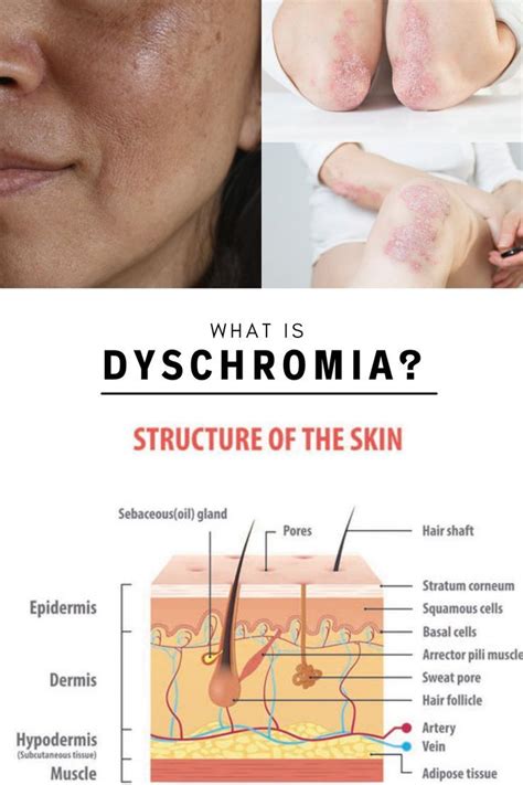 Kim Kardashian's Dyschromia Skin Disorder in 2022 | Subcutaneous tissue ...