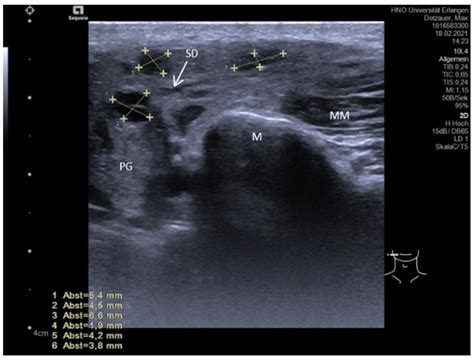 Parotid Gland Swelling Ultrasound