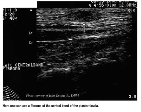 Diagnostic Ultrasound: Can It Have An Impact For Plantar Fasciitis?