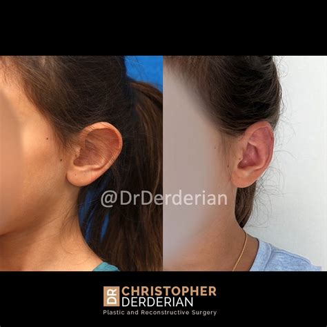 Reduction Otoplasty — Dr Derderian — Plastic and Reconstructive Surgery