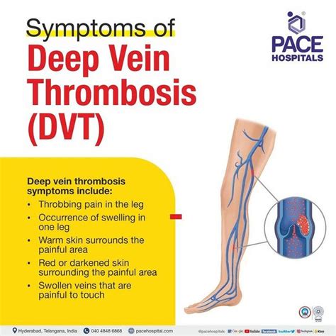 Deep Vein Thrombosis, DVT Symptoms, Causes And, 59% OFF