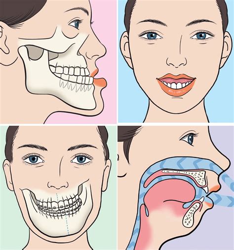 What is Orthognathic Surgery?