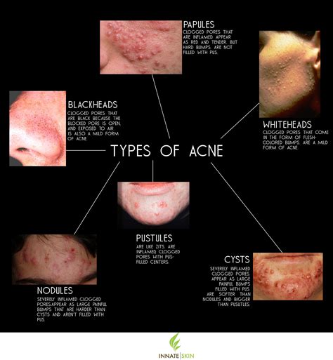 How to Recognize What Kind of Acne You Have | Innate Skin