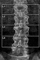 Bone Density Scan (DXA) | UCSF Radiology