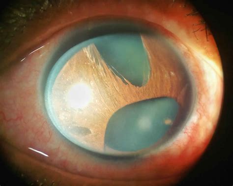 Iridocorneal endothelial syndrome, causes, symptoms, diagnosis ...