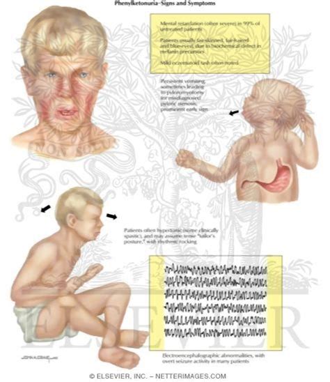 Birth Defects: Phenylketonuria (PKU) - Signs and Symptoms. PKU is an ...