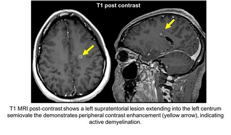 Sixth nerve palsy – Case-Based Neuro-Ophthalmology