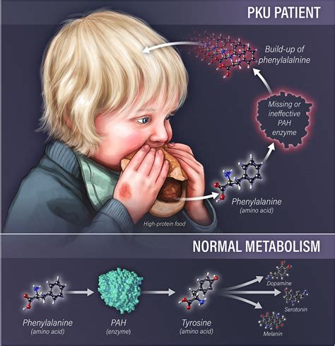 PKU Poster — Hannah Bryce Ely, CMI