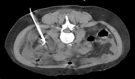 Abscess Drainage: Case 3 — Albany IR