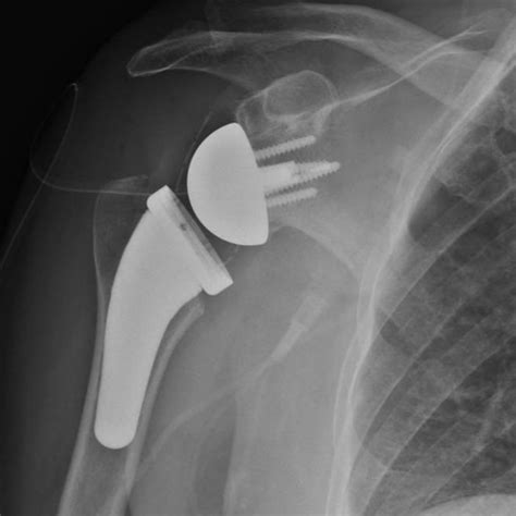 My Reverse Shoulder Replacement - Patient Story - Orthopedic ...