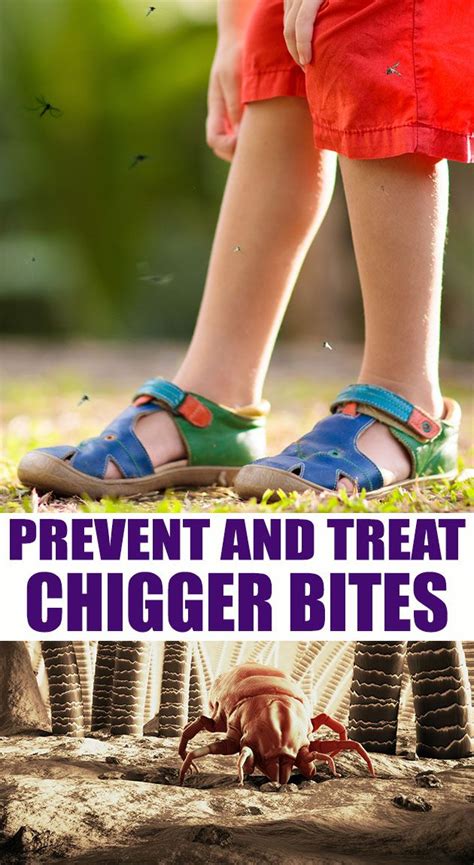 How to Prevent and Treat Chigger Bites | Chigger bites, Holistic ...