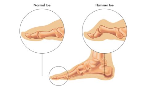 Hammertoes Treatment without Surgery: Top Options