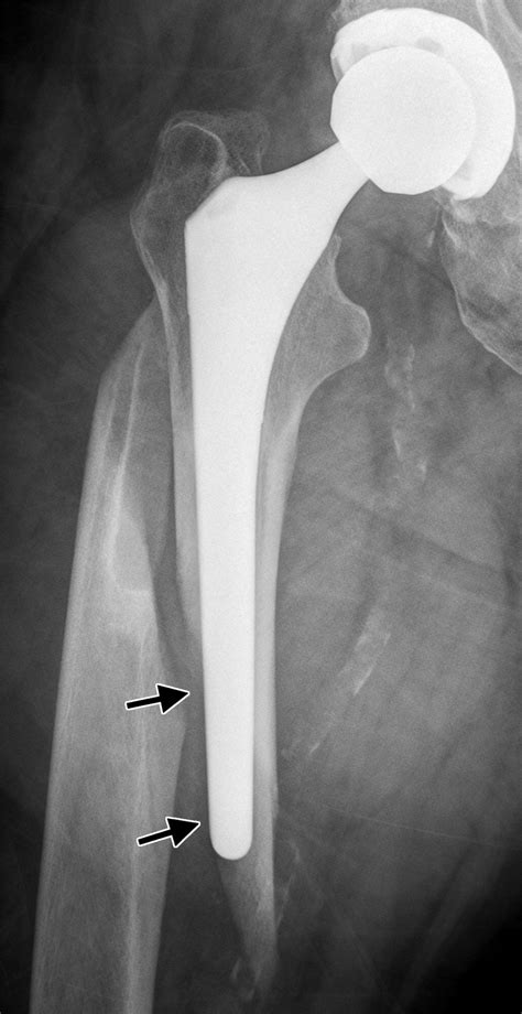 Periprosthetic Femoral Fractures in the Emergency Department: What the ...