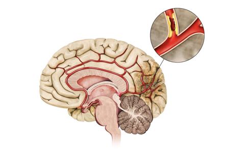 Cerebral Infarction: What Is Cerebral Infarction?