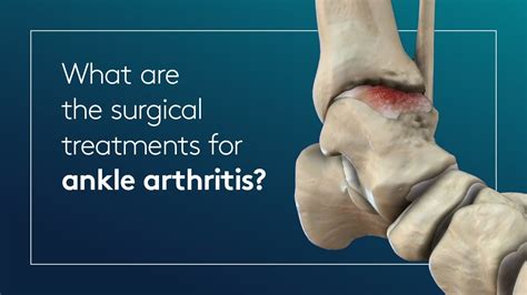 Foot And Ankle Arthritis Causes Symptoms And Treatment – Otosection