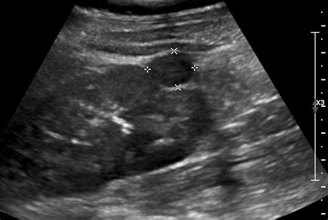 Renal Cell Carcinoma Ultrasound