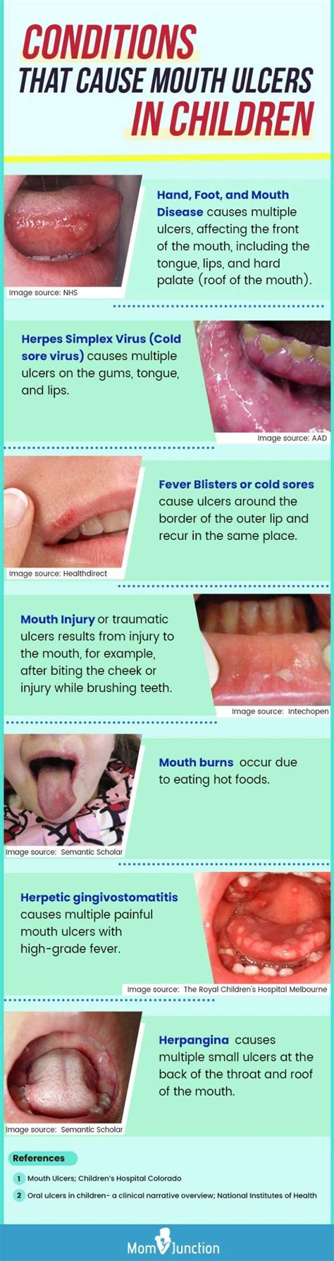 Multiple Canker Sores Under Tongue