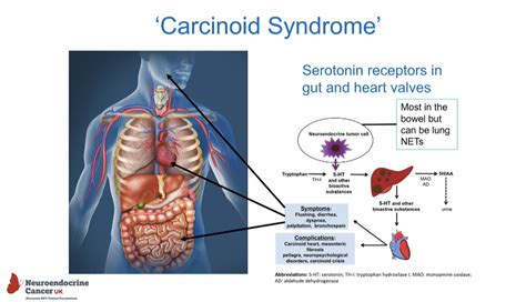 Carcinoid Syndrome Flush