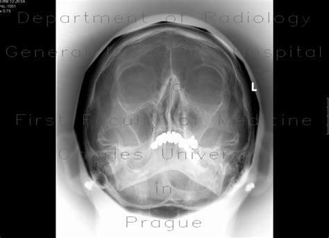 Radiology case: Chronic sinusitis of the left maxillary sinus