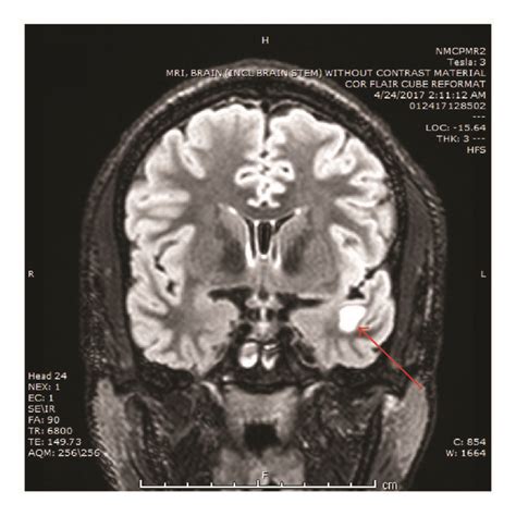 Brain MRI demonstrating left temporal lobe lesion. (a, c) Axial and ...