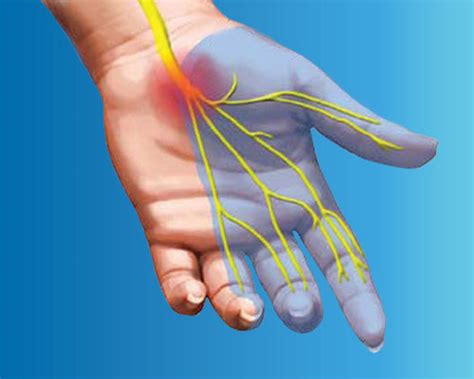 Carpal Tunnel Rarely Causes Permanent Nerve Damage