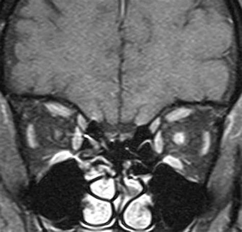 Normal Optic Nerve Mri