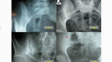 The Diagnosis and Management of Axial Spondyloarthritis - YouTube