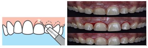 Gingivectomy & Gingivoplasty - Focus Dentistry