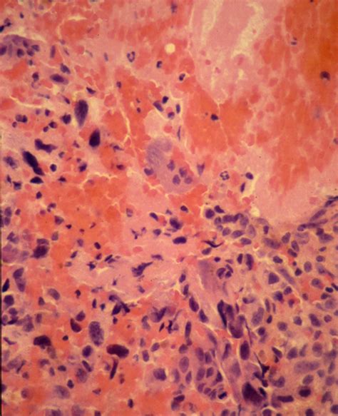 Histology Of Osteosarcoma