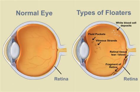 Muscae Volitantes - Ruồi bay trong mắt người