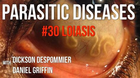 Parasitic Diseases Lectures #30: Loiasis - YouTube