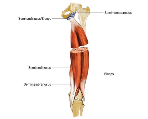 Proximal Hamstring Tendon Rupture