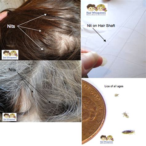 Head Lice Treatment Pictures | Hair Whisperers | LA | SD