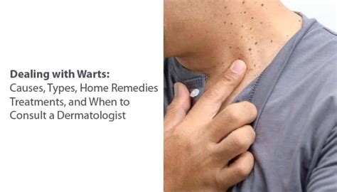 Beast Treatment Procedure for Warts: Causes & Its Types